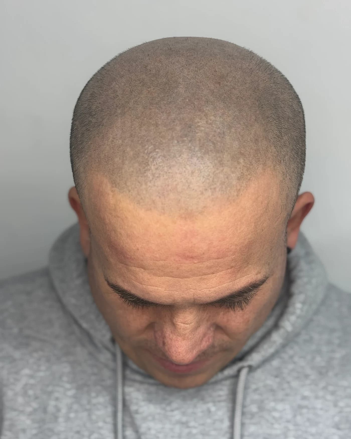 Resultado de una micropigmentación capilar en Capillaric