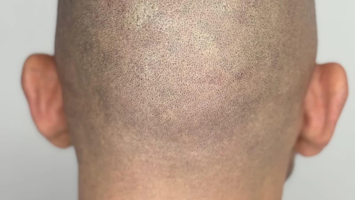 Resultado de micropigmentación capilar visto desde atrás