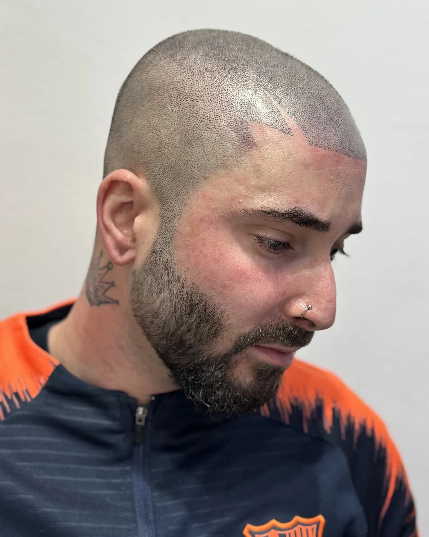 Resultado capilar visto de perfil